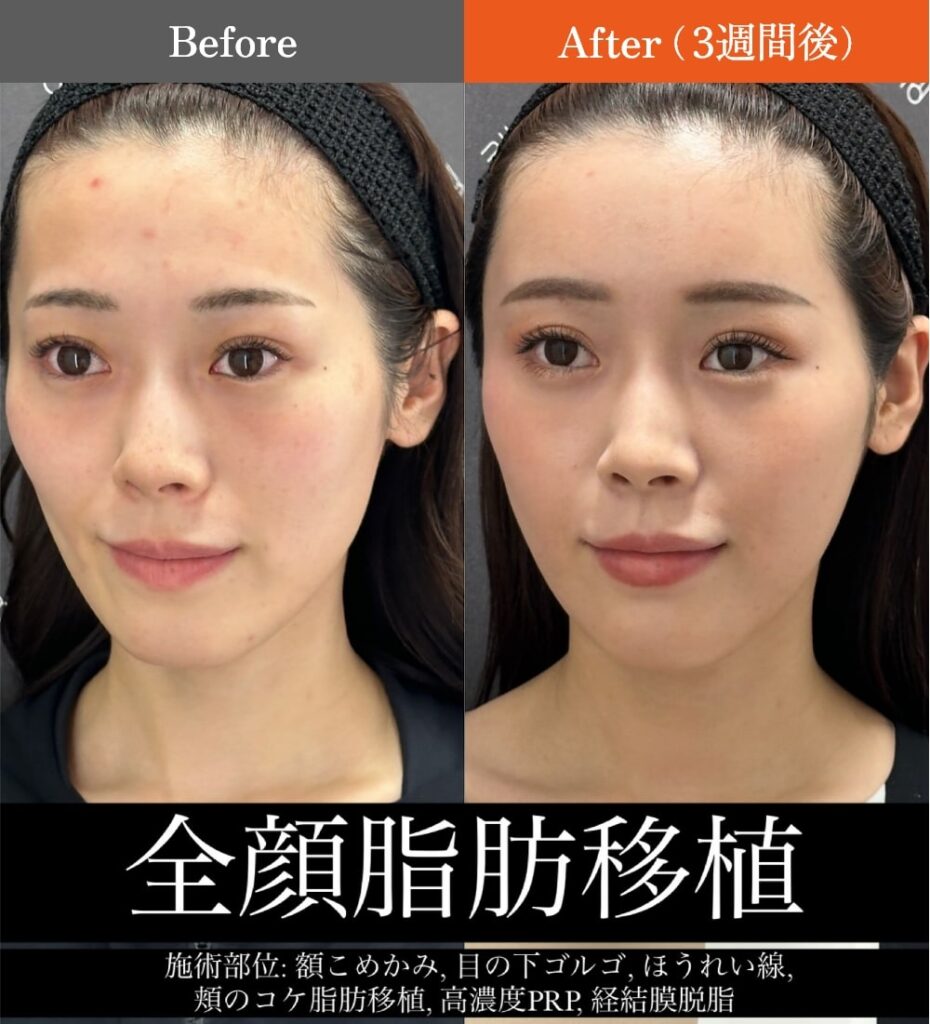 全顔脂肪注入のビフォーアフター