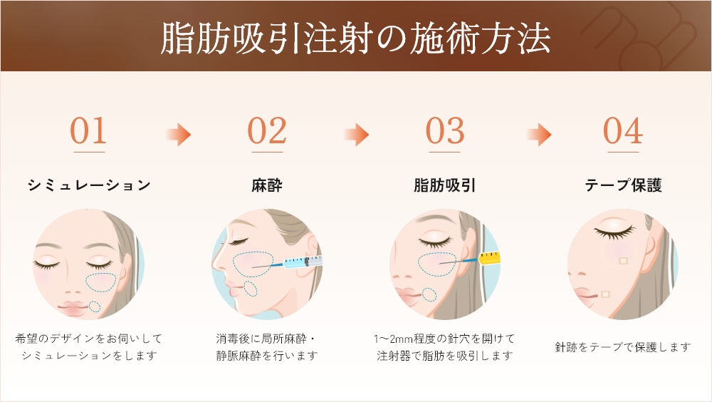 小顔脂肪吸引注射の施術方法