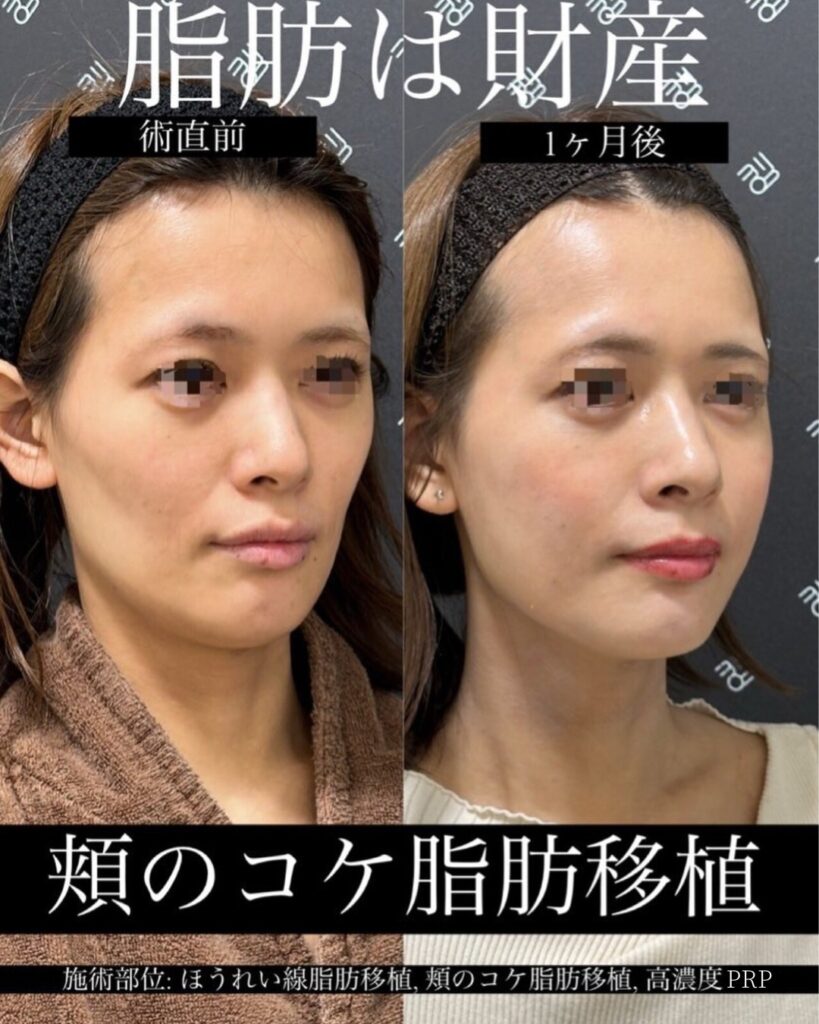 頬の脂肪移植のビフォーアフター