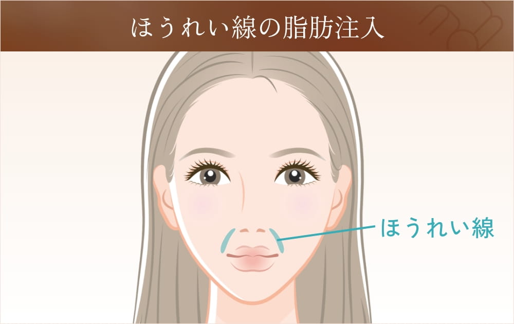 ほうれい線脂肪注入の範囲を示すイラスト