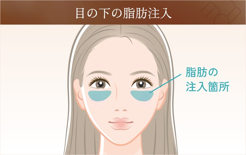 目の下の脂肪注入の範囲を示すイラスト
