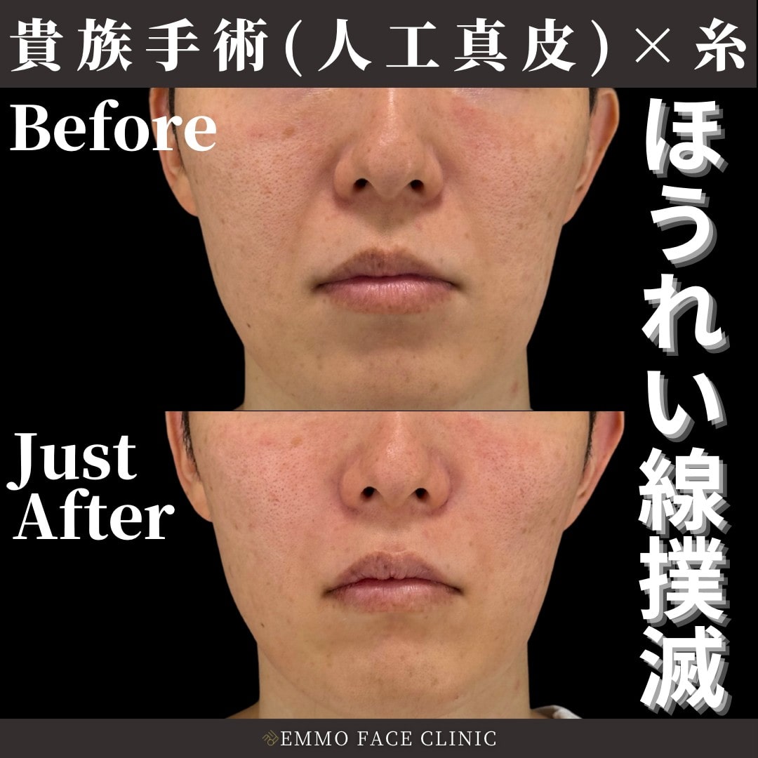 人工真皮症例写真01