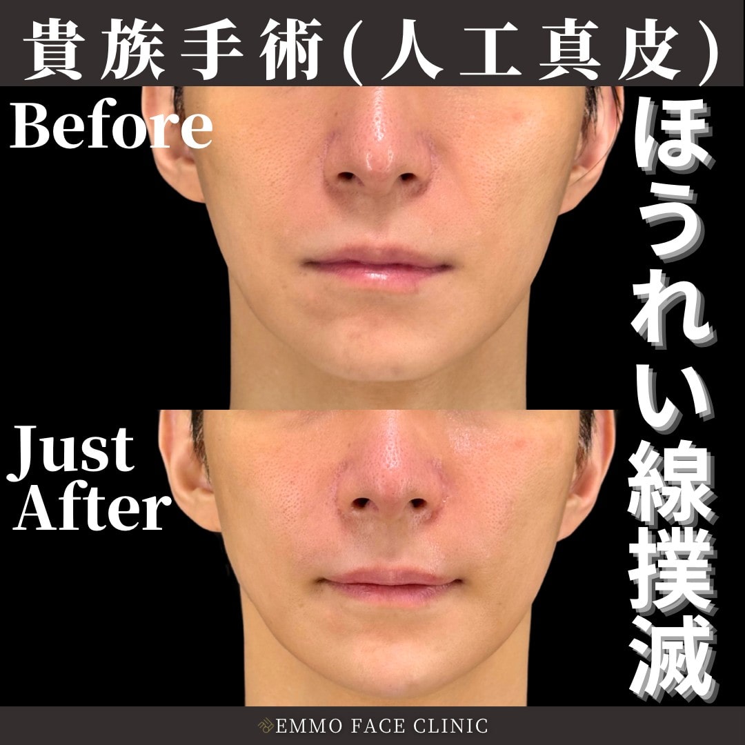 人工真皮症例写真02