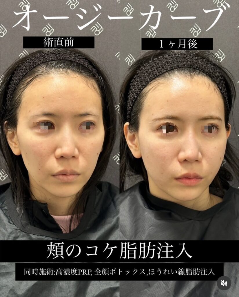 頬のコケ脂肪注入