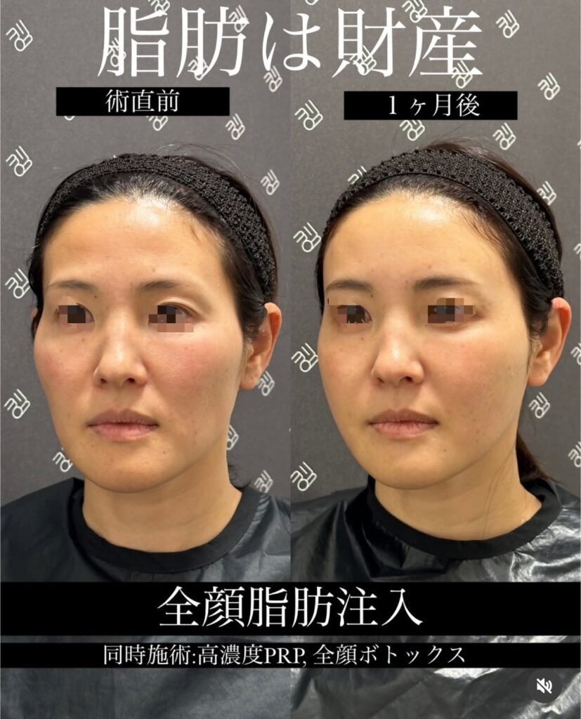 全顔脂肪注入