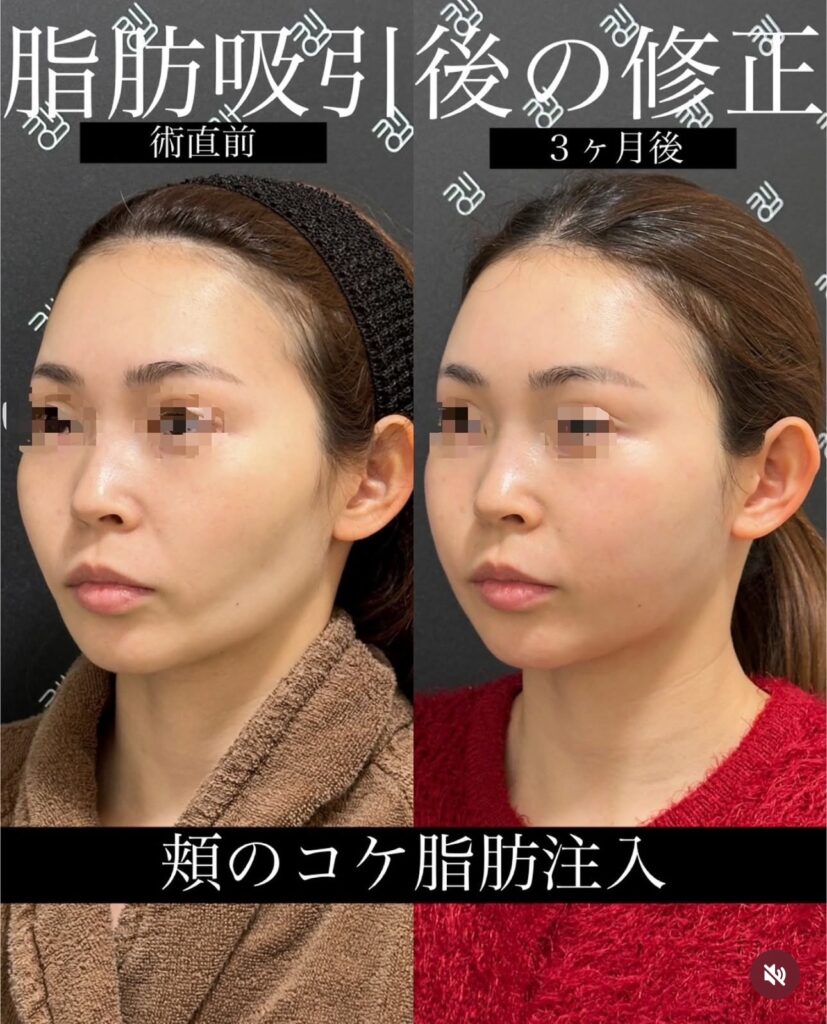 頬のコケ脂肪注入