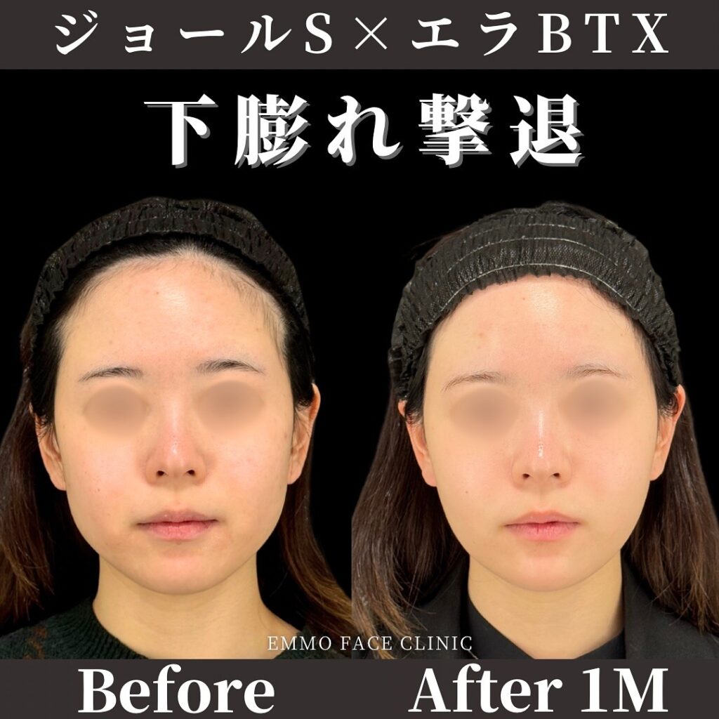 ジョールファット除去とエラボトックス注射のビフォーアフター