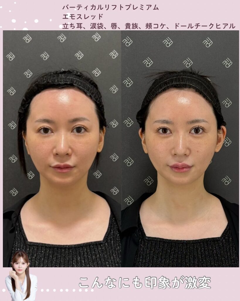 糸リフト+ヒアルロン酸のビフォーアフター