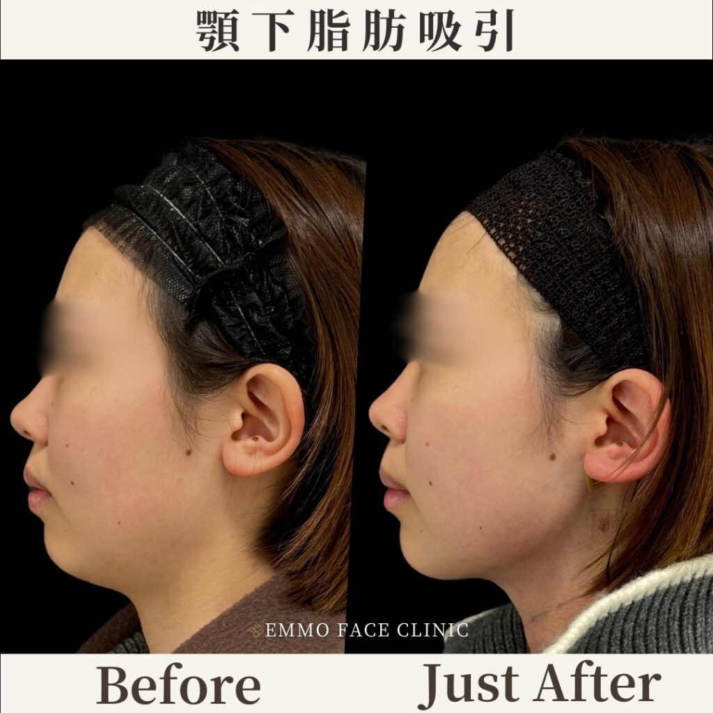 顎下脂肪吸引と糸リフトのビフォーアフター