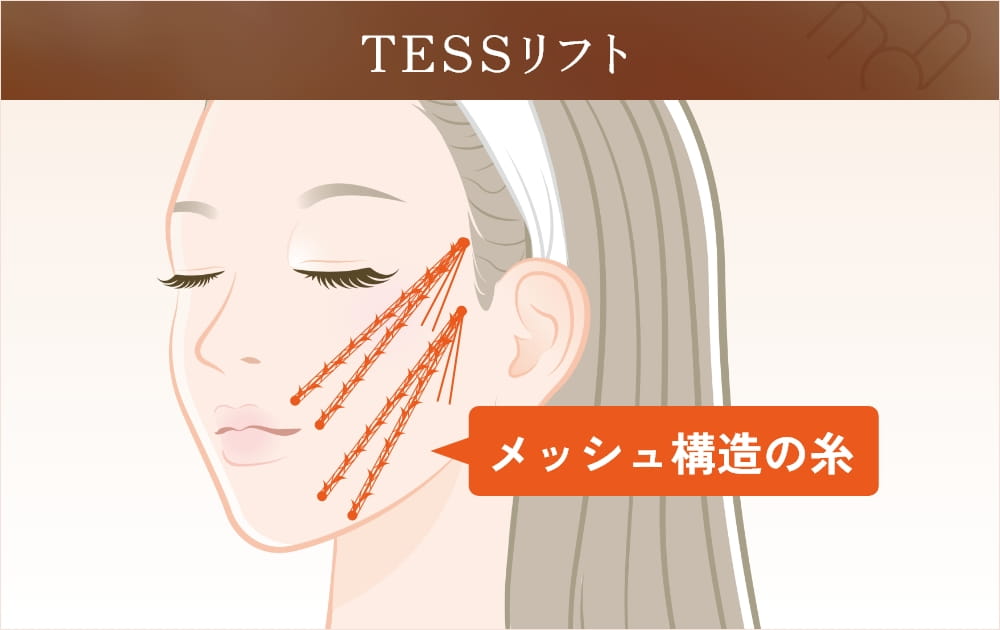 TESSリフトの解説図