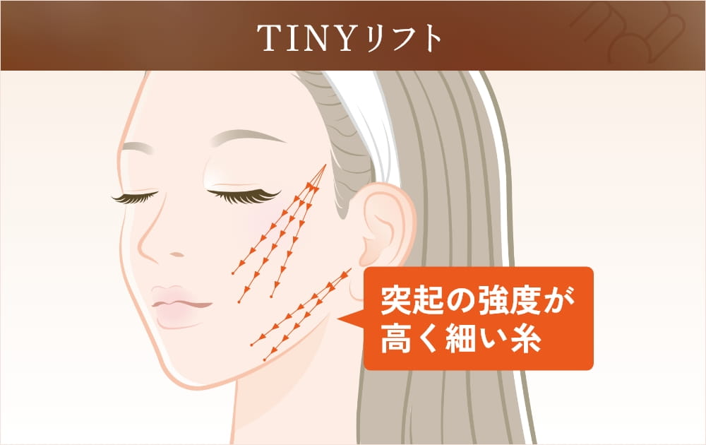 TINYリフトの解説図