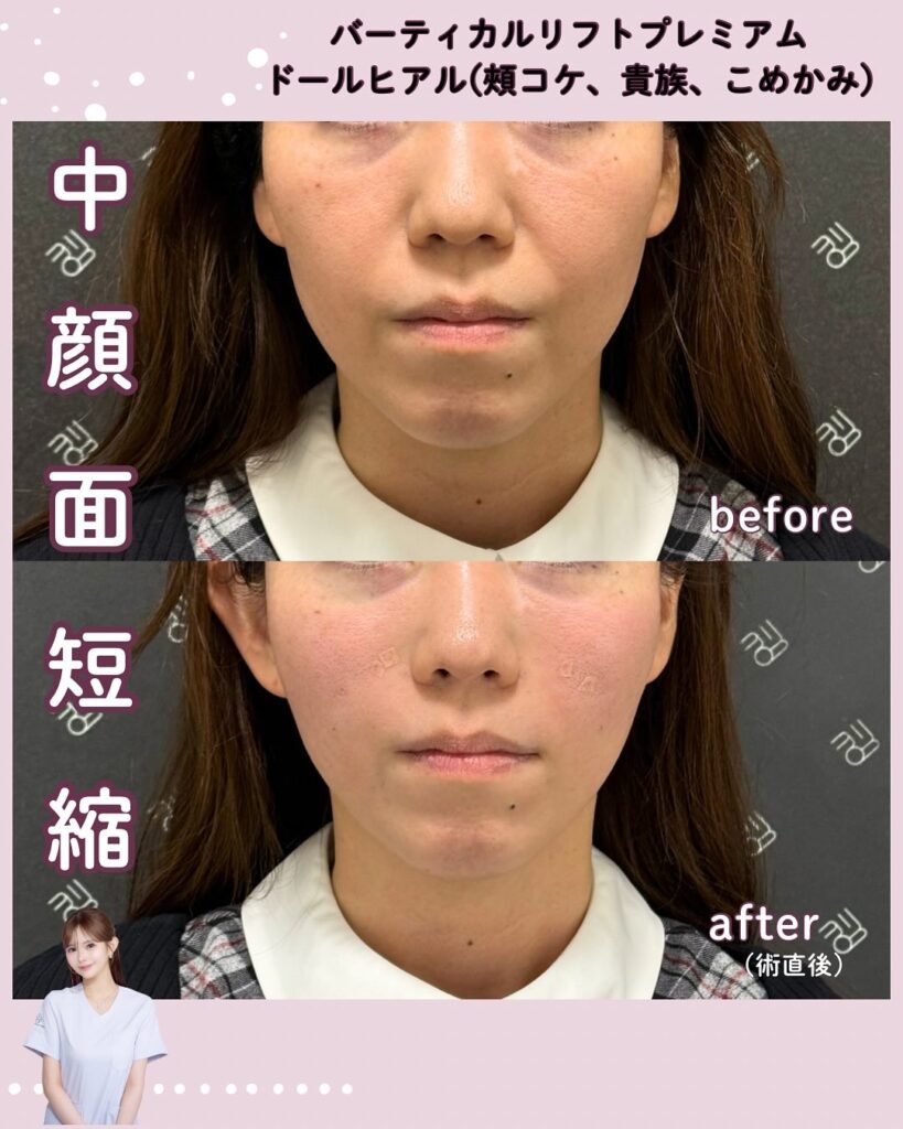 バーティカルリフトプレミアム+ヒアルロン酸フィラーのビフォーアフター