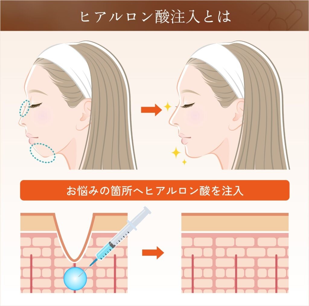ヒアルロン酸注射による顔の施術説明図