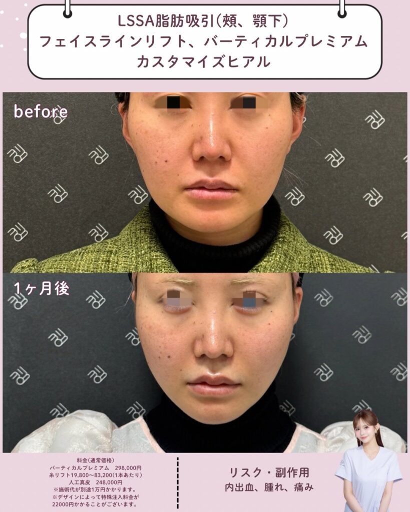 LSSA脂肪吸引×フェイスラインリフト×バーティカルリフト×カスタマイズヒアル
