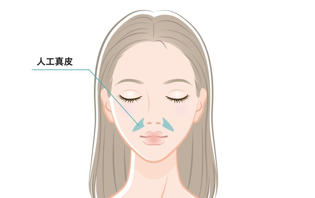 目の下と鼻翼基部に人工真皮を指す女性の顔