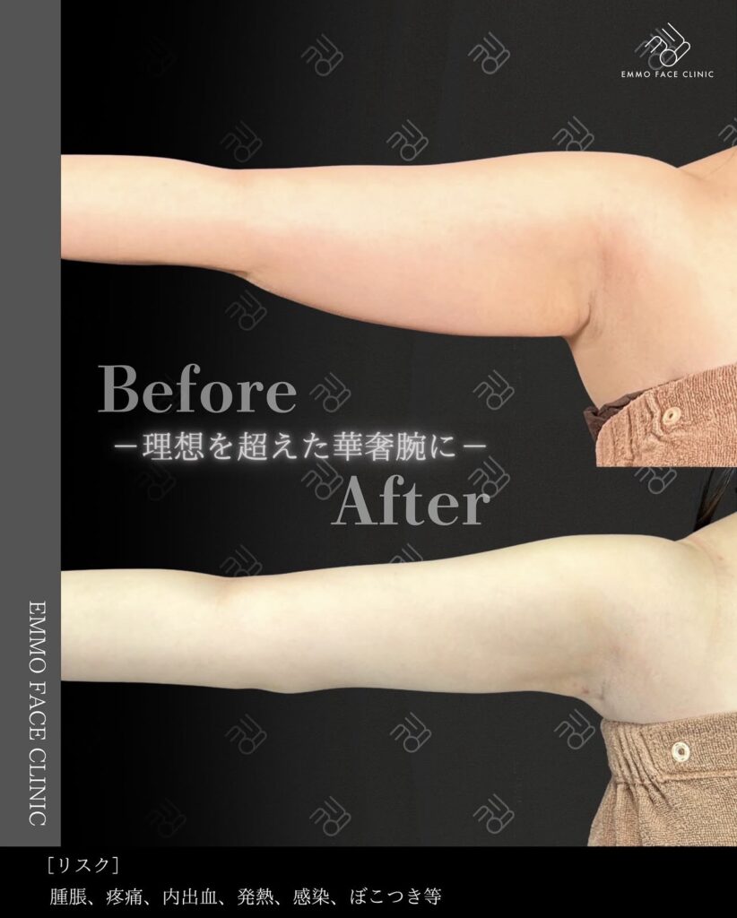 二の腕脂肪吸引ー症例写真