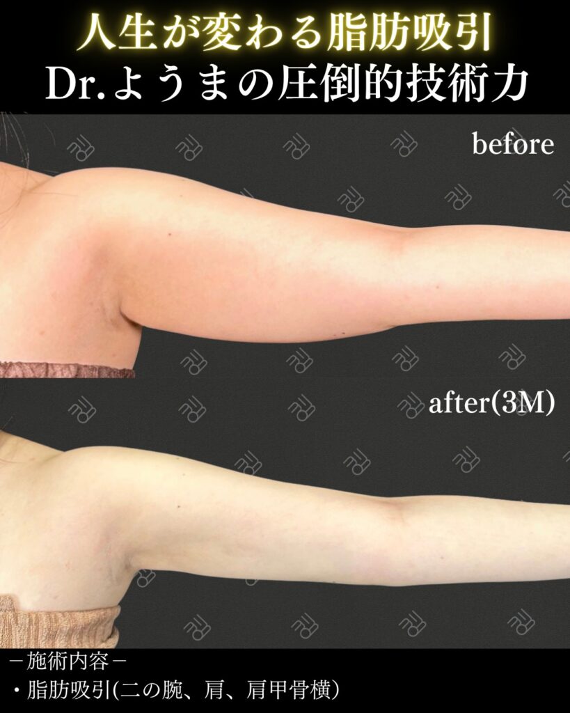 二の腕脂肪吸引のビフォーアフター（正面）