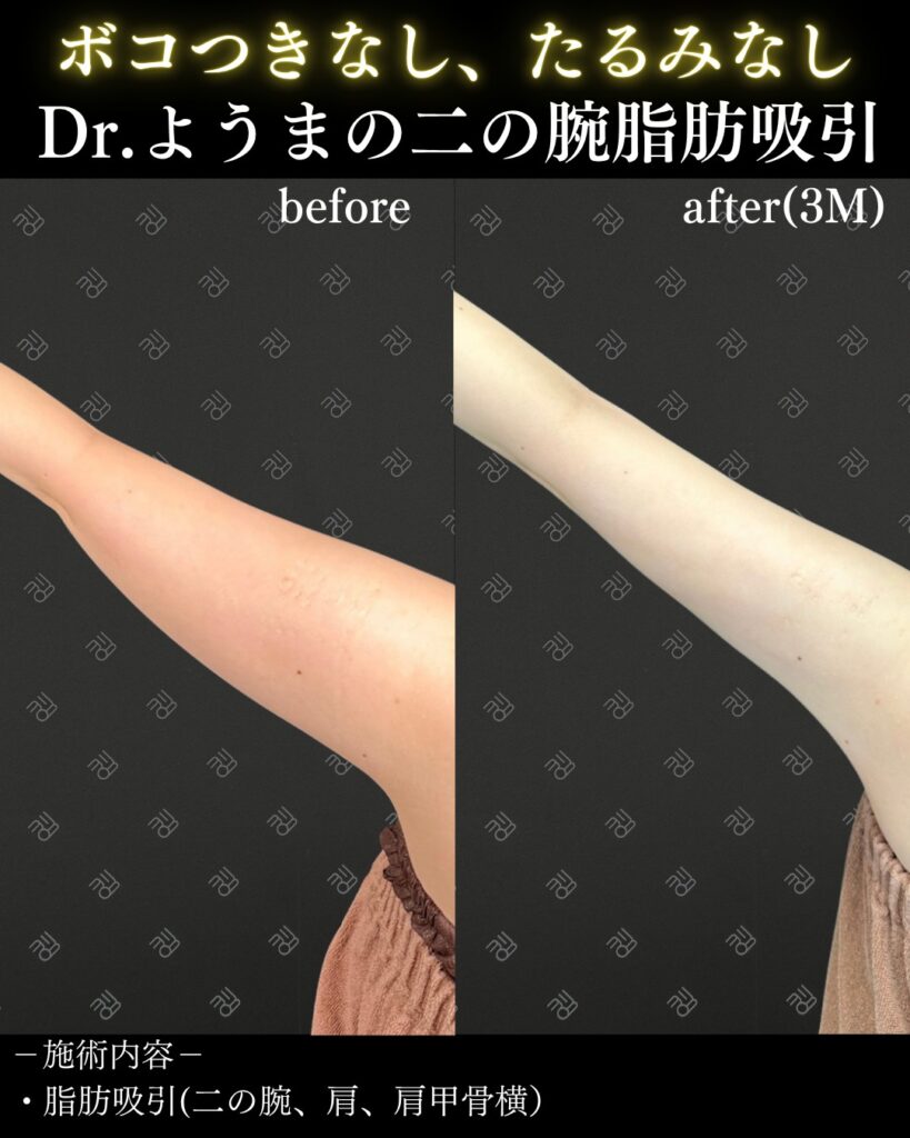 二の腕脂肪吸引のビフォーアフター（斜め）