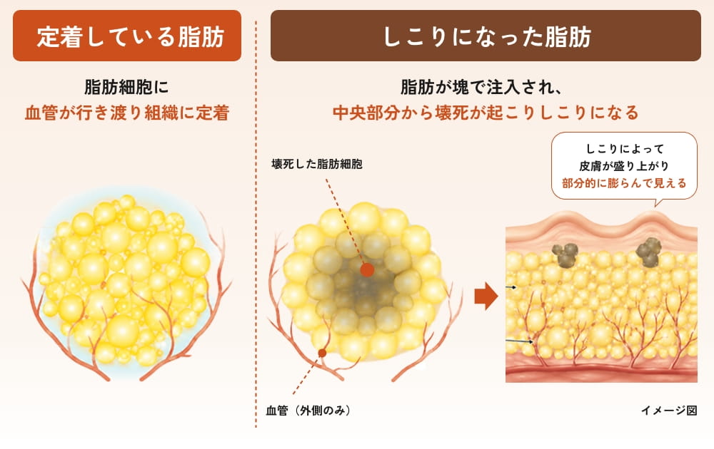 定着脂肪と塊脂肪の組織比較