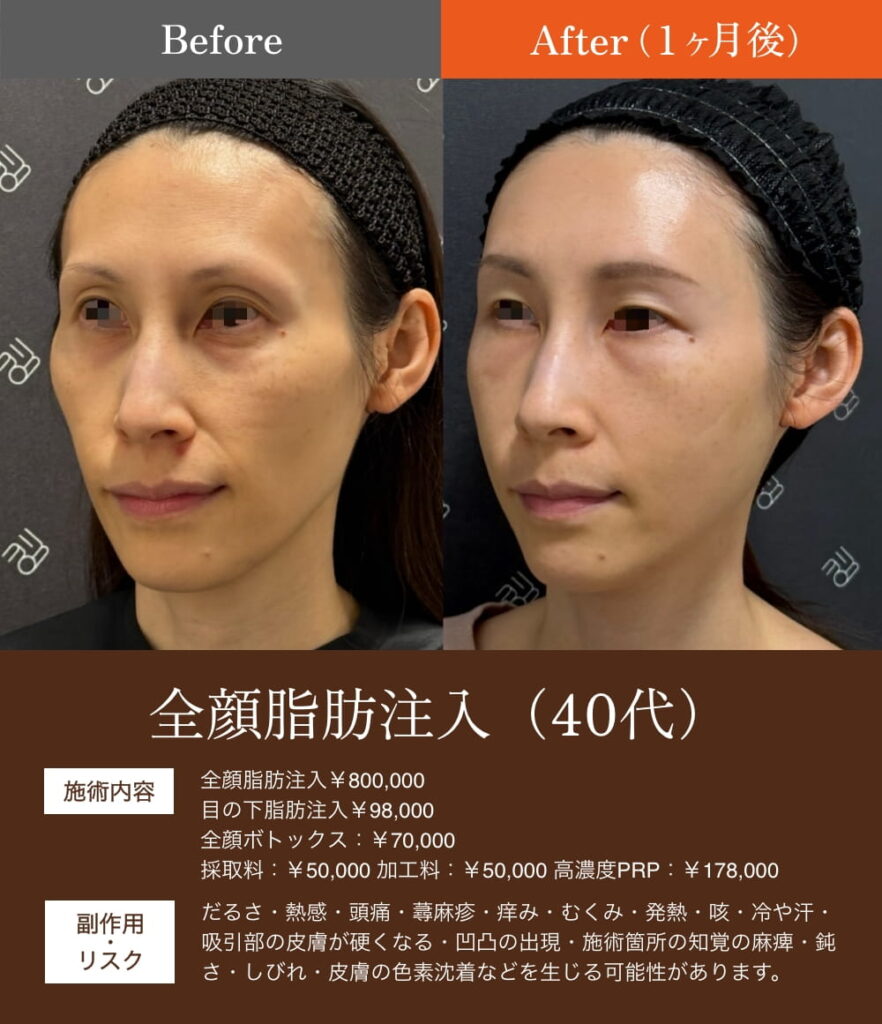 40代女性の術前術後比較 左斜めからの顔