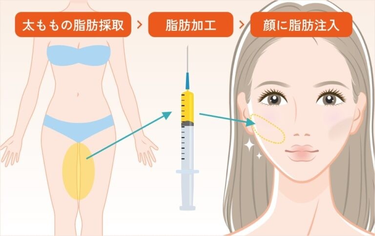 脂肪を採取し顔に注入する施術の流れ