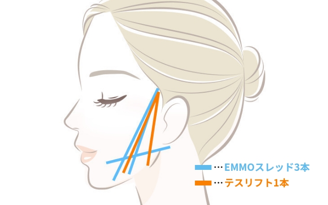 2方向から強力にリフトアップ