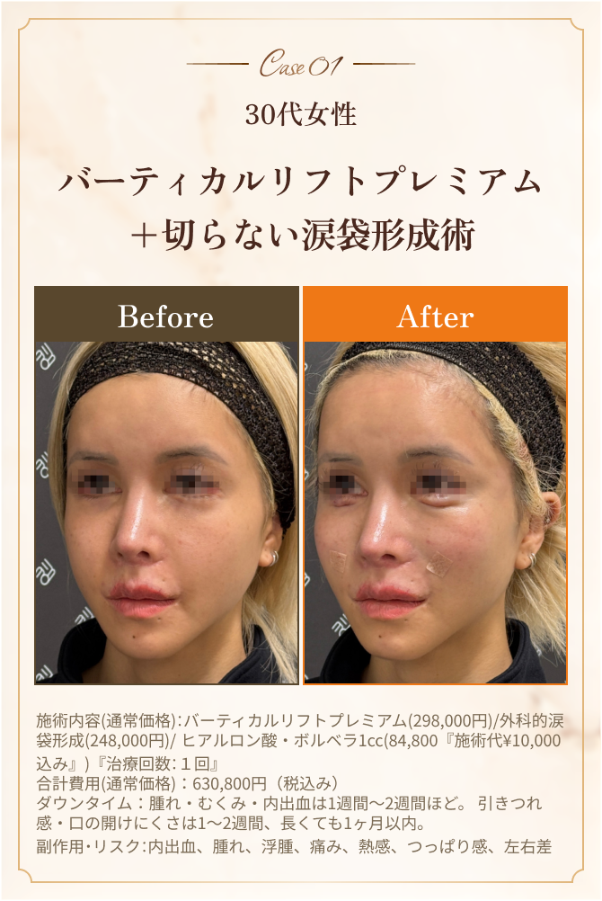 バーティカルリフトプレミアムと切らない涙袋形成術の症例