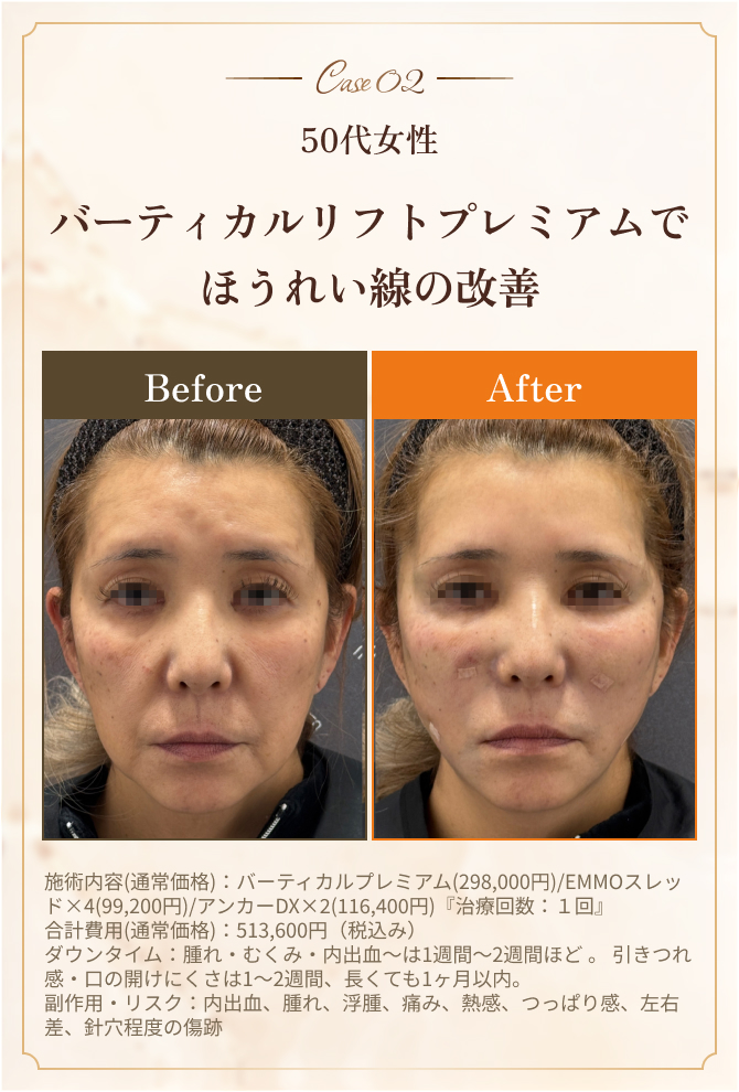 バーティカルリフトプレミアムでほうれい線の改善
