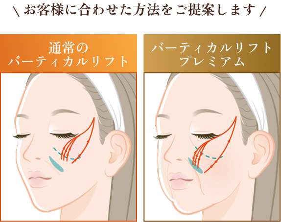 バーティカルリフトとバーティカルリフトプレミアムの施術方法の違い