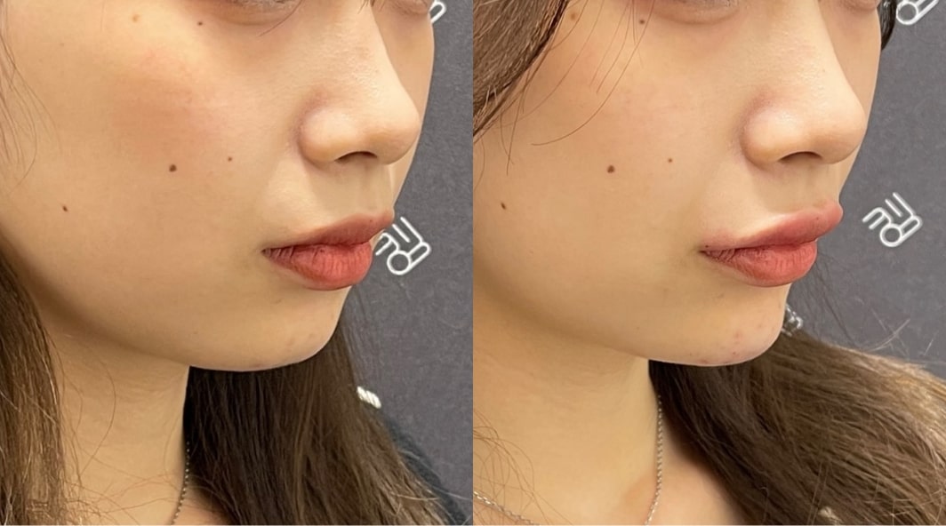 部分モニターで目から下の顔が映っている術前・術後の女性。