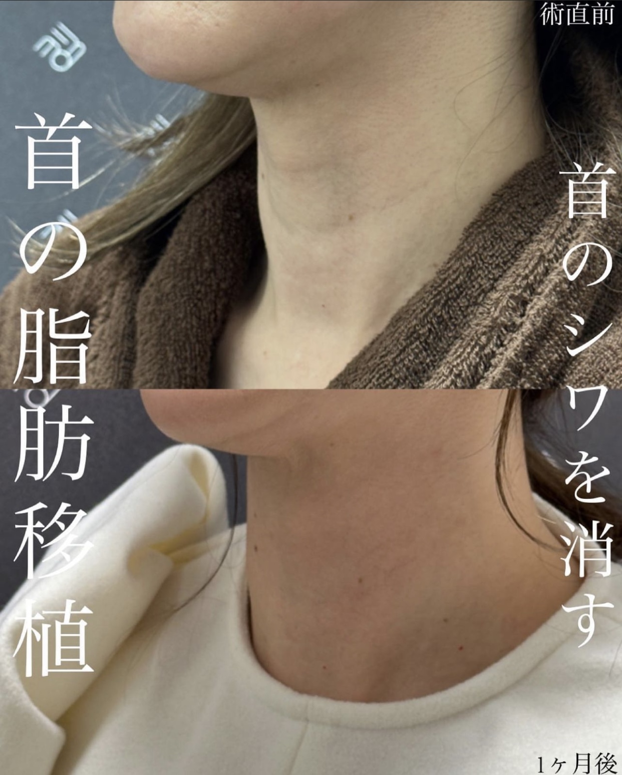 首に脂肪が溜まると首が太くなることがありますか? – 首が痩せる原因 – EMSRY
