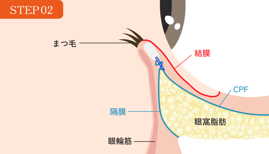 STEP02