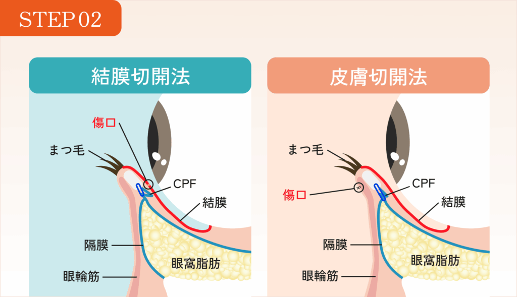 STEP02