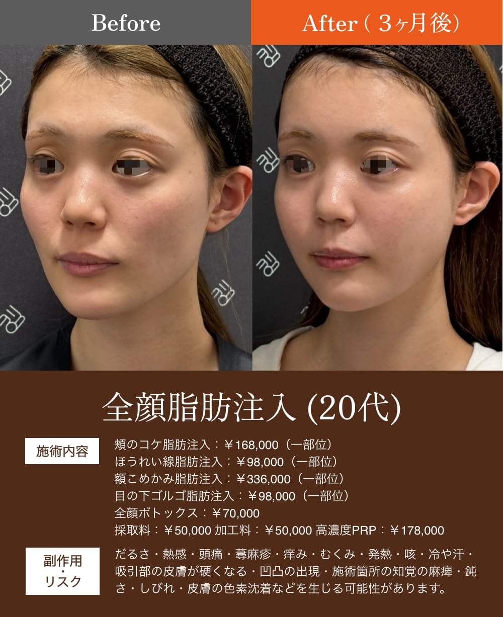 脂肪注入前後の女性の顔の変化