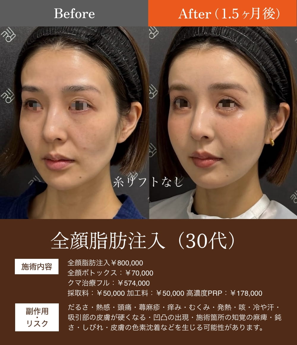 脂肪注入前後の女性の顔比較