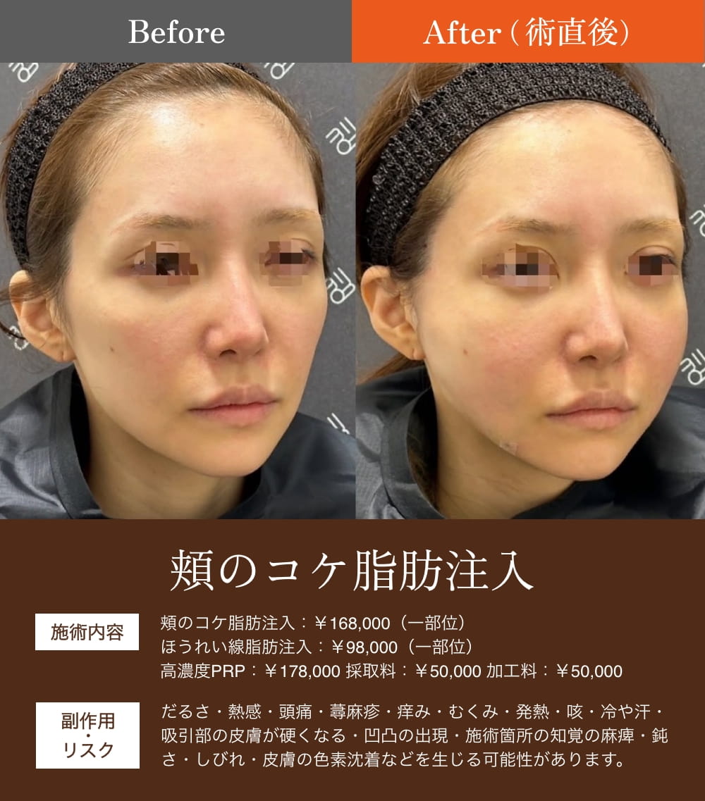 頬の脂肪注入術前と術後の比較