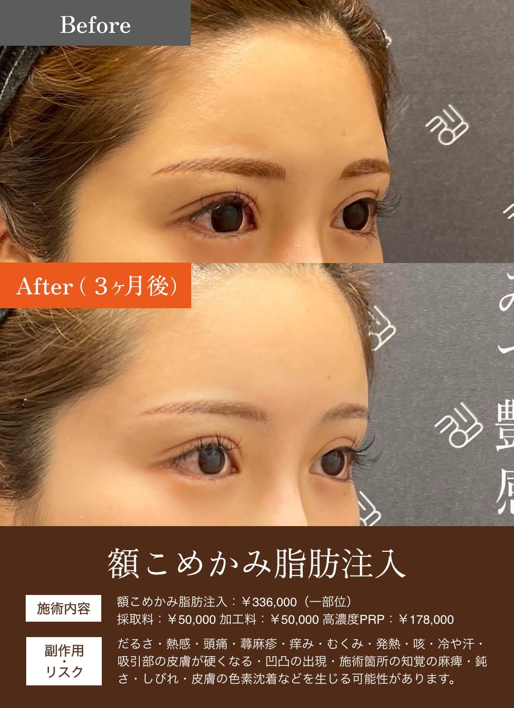 額とこめかみの脂肪注入前後比較女性の顔