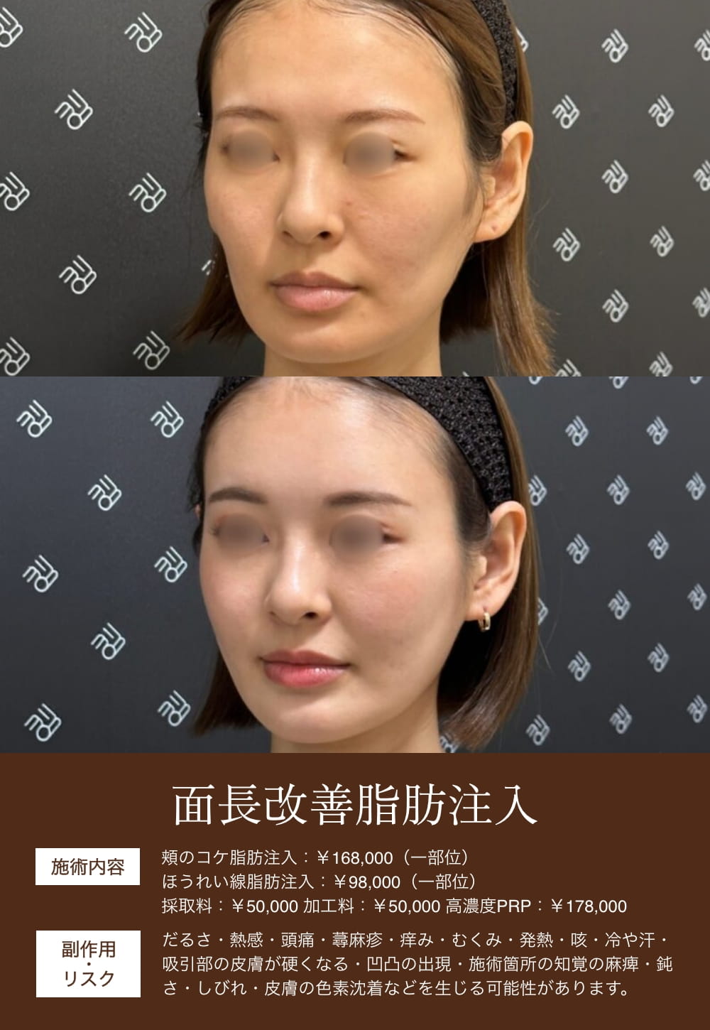 面長改善脂肪注入のビフォーアフター
