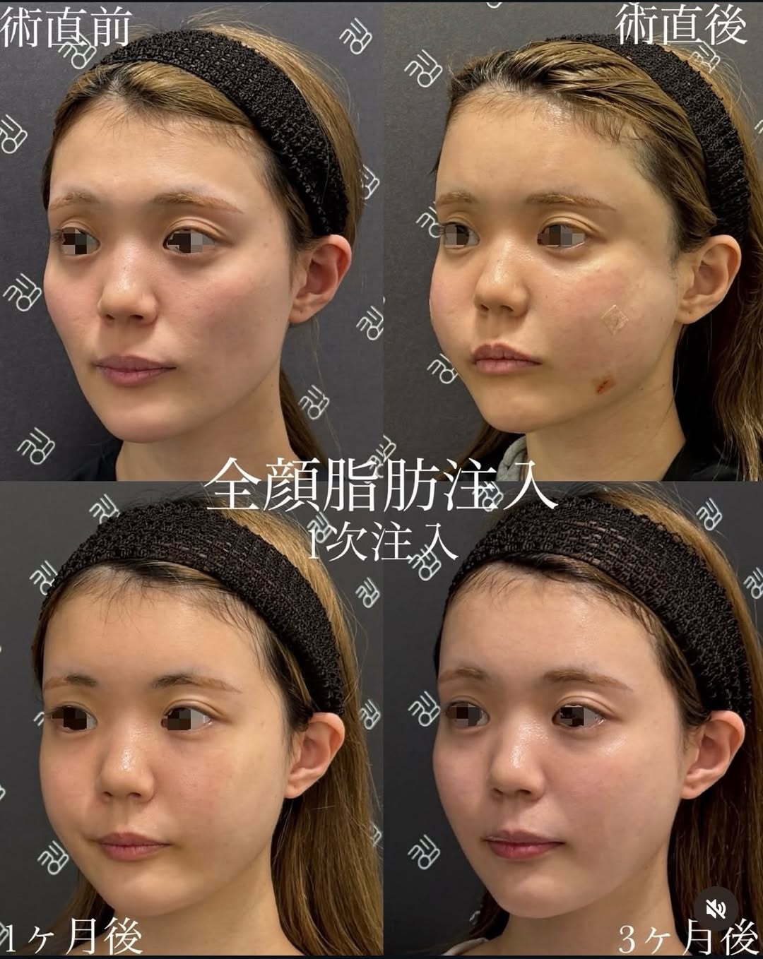 脂肪注入前後のダウンタイム経過