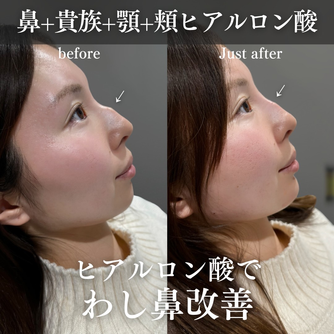 ヒアルロン酸ー症例写真