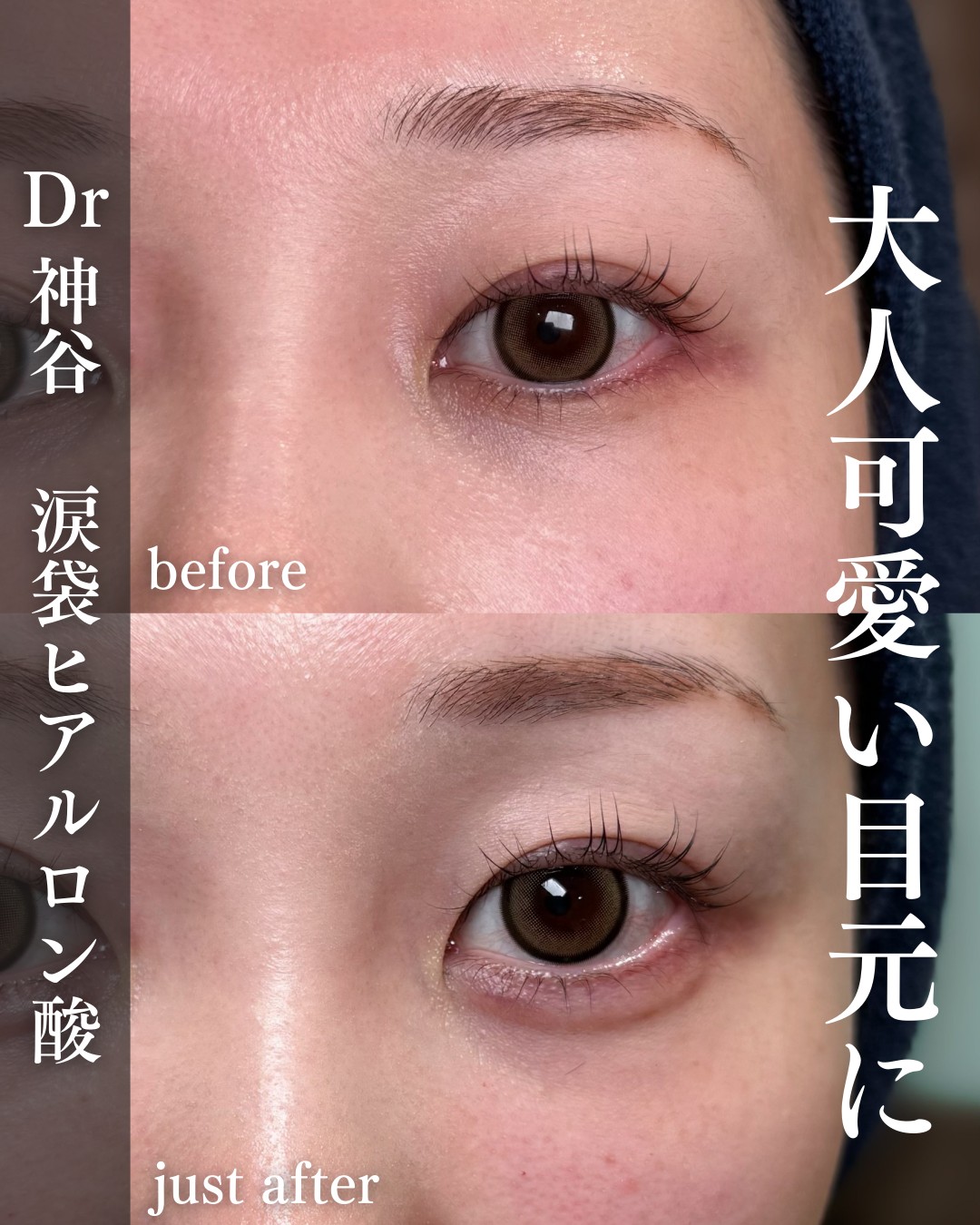 涙袋ヒアルロン酸ー症例写真
