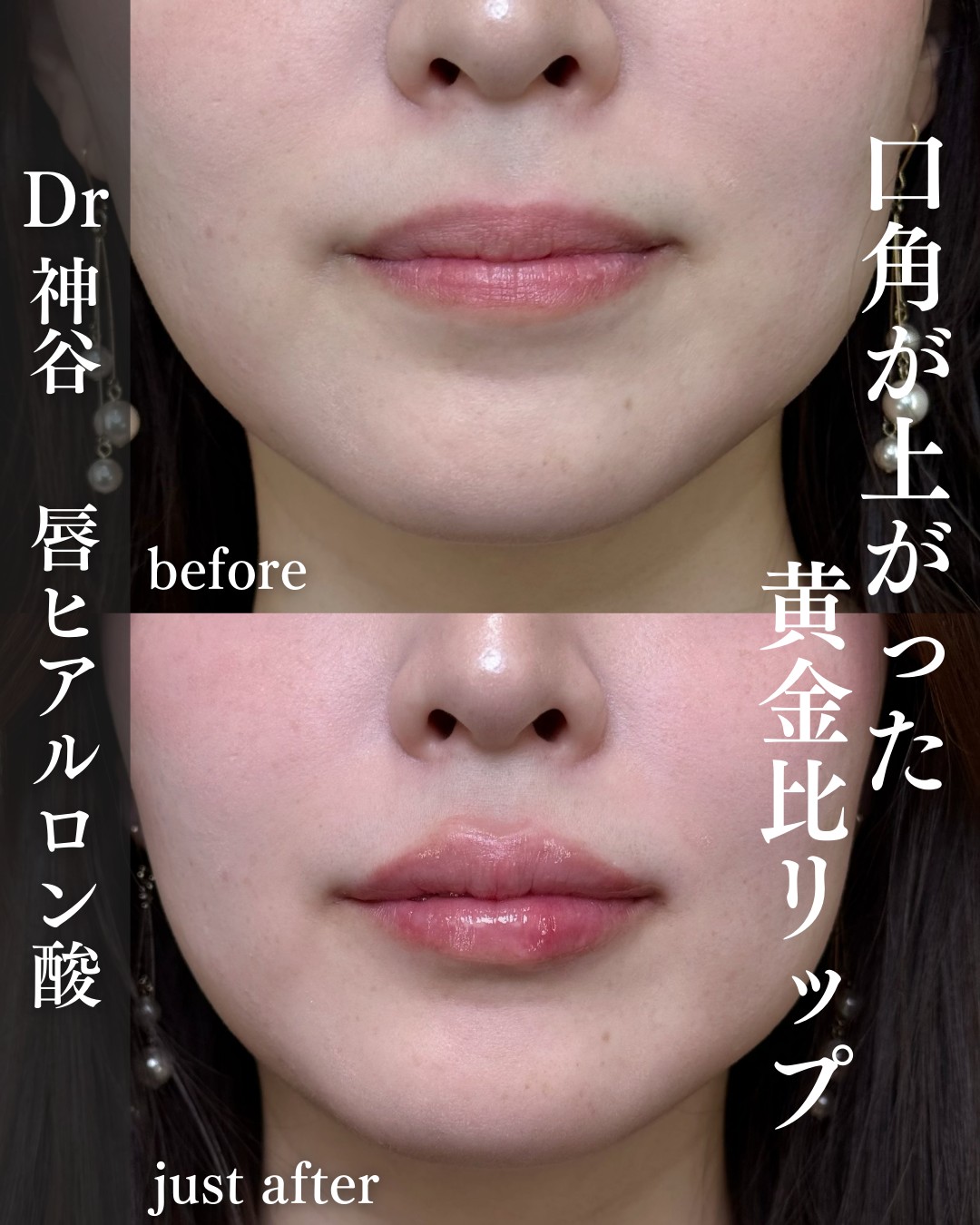 唇ヒアルロン酸ー症例写真
