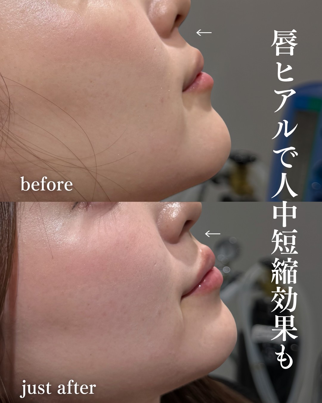 唇ヒアルロン酸ー症例写真