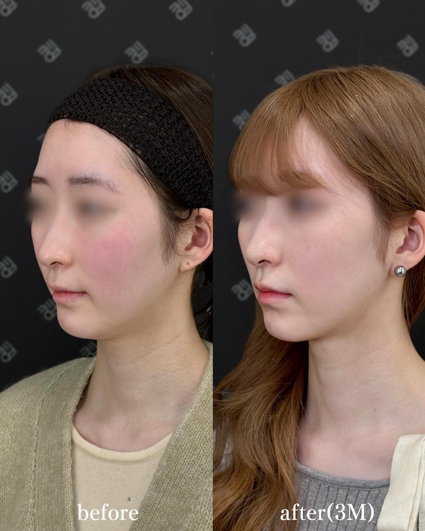 脂肪吸引注射ー症例写真