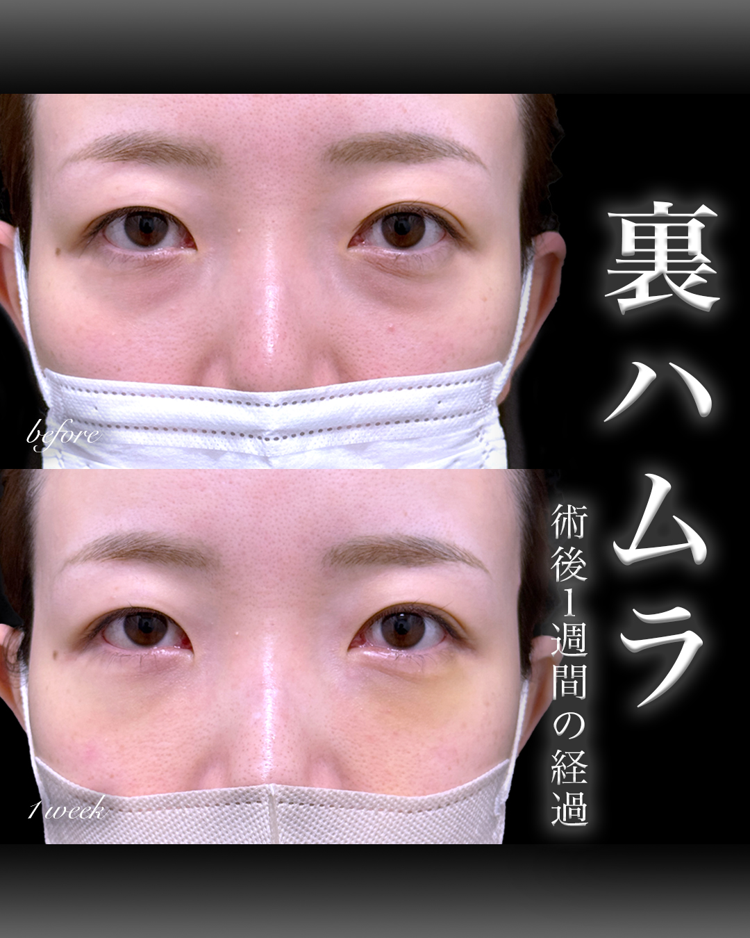 裏ハムラ症例写真