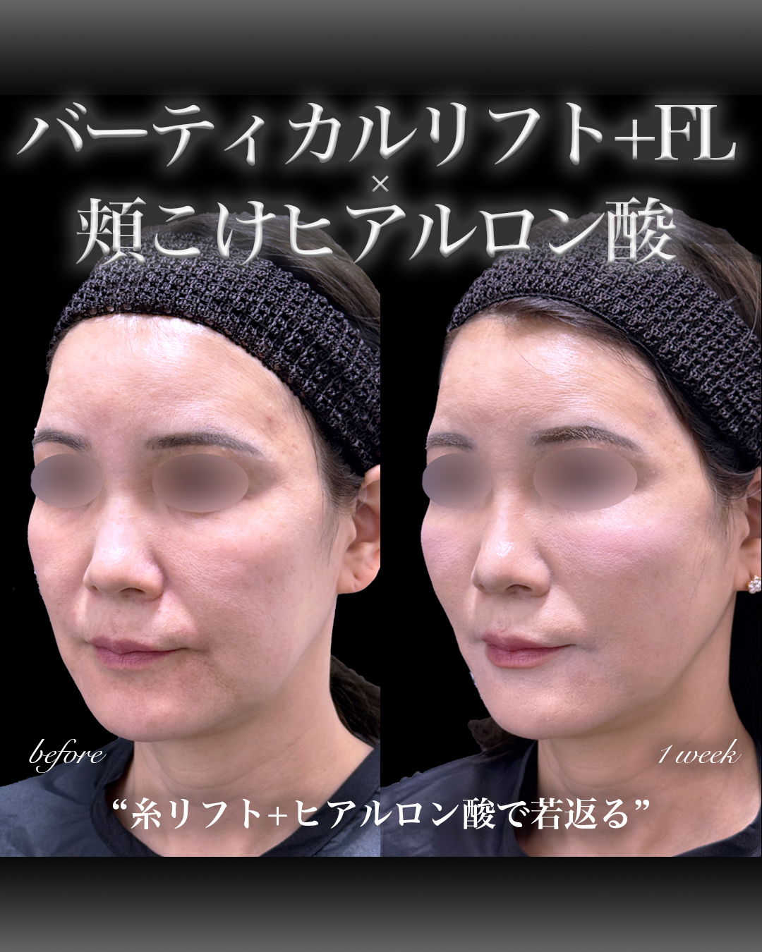 バーティカルリフト＋ヒアルロン酸症例写真