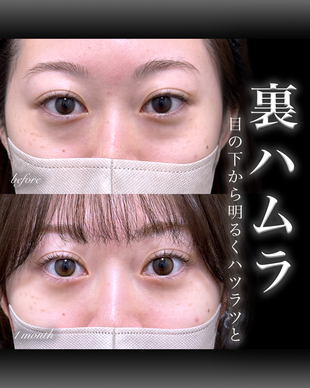 裏ハムラ症例写真