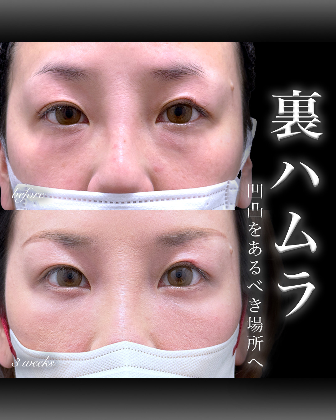 裏ハムラ症例写真