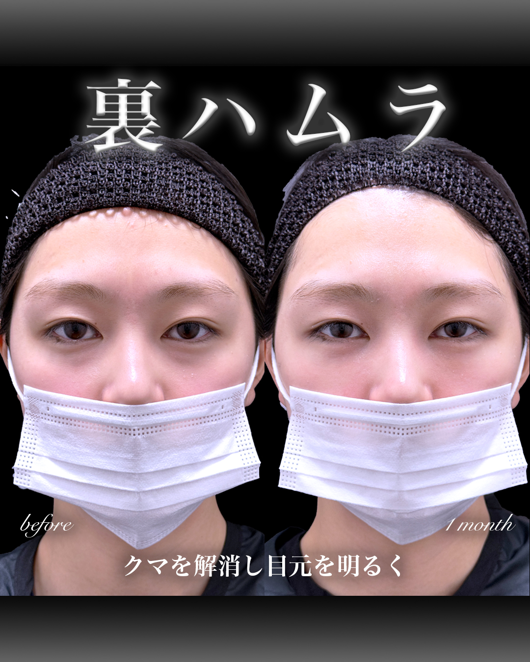 裏ハムラ症例写真