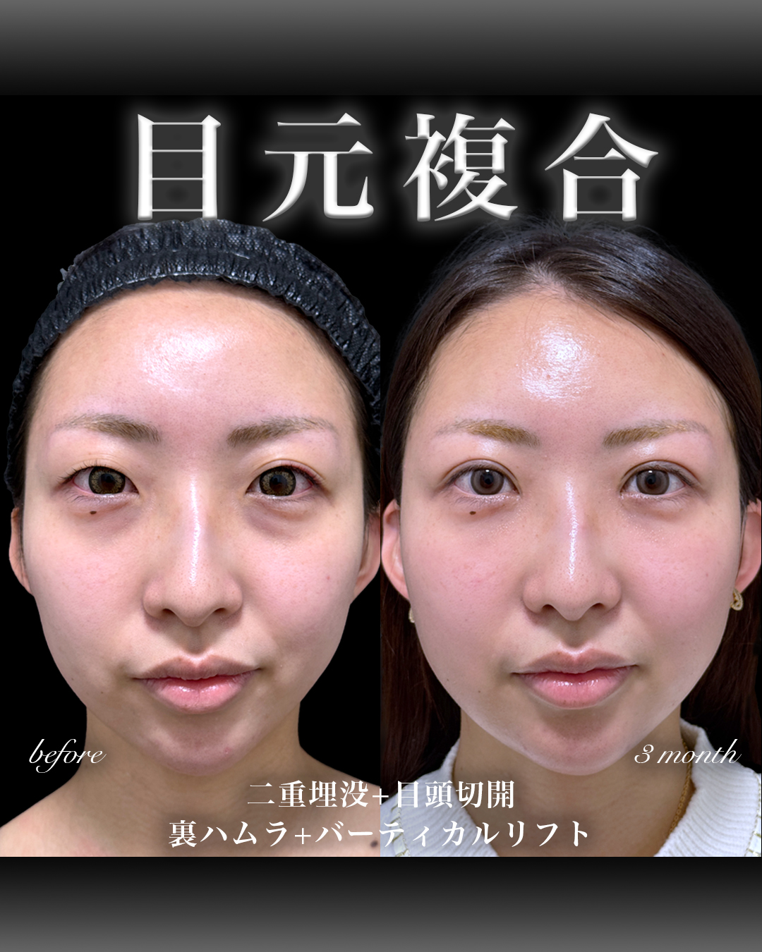バーティカルリフト＋二重埋没＋裏ハムラ＋目頭切開症例写真